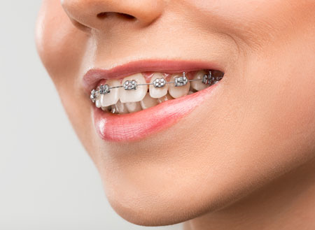 Orthodontic package at Al Joman Advanced Medical Complex for 499 SAR