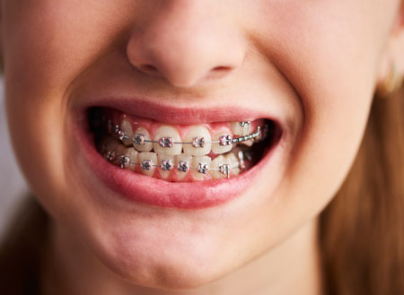 Orthodontic package at \
